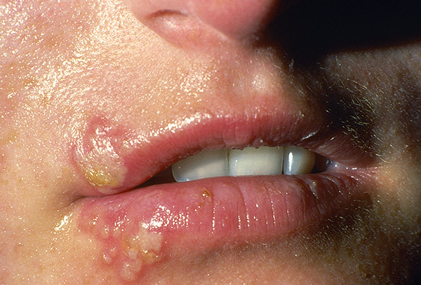 Чтобы заболевание не появлялось вновь и вновь, важно повышать иммунитет - вот только далеко не все иммуностимулирующие препараты этому способствуют... Чтобы заболевание не появлялось вновь и вновь, важно повышать иммунитет - вот только далеко не все иммуностимулирующие препараты этому способствуют...