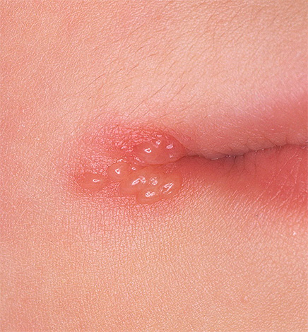 Если вовремя не начать лечение, то появления язвочек будет уже не избежать Если вовремя не начать лечение, то появления язвочек будет уже не избежать