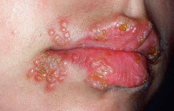 Выясняем специфику так называемого лабиального герпеса - что это за заболевание такое и как с ним можно бороться... Выясняем специфику так называемого лабиального герпеса - что это за заболевание такое и как с ним можно бороться...