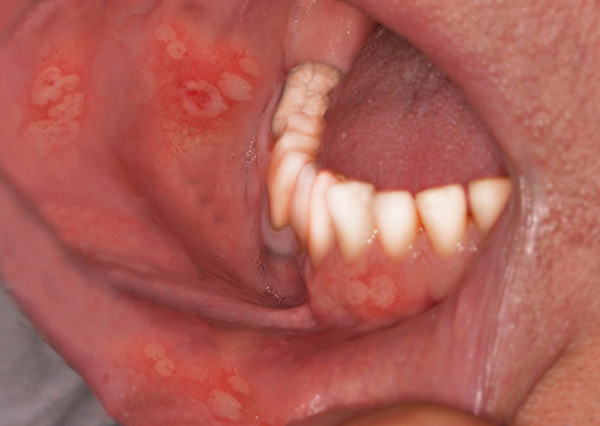 На фотографии показан пример герпетического стоматита. На фотографии показан пример герпетического стоматита.