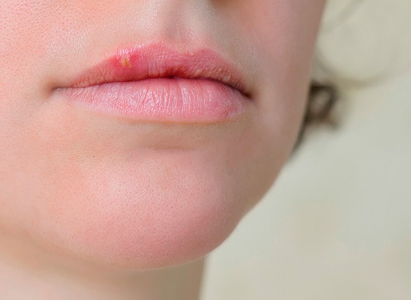 К счастью, в большинстве случаев заболевание протекает легко и не вызывает серьезных осложнений у больного. К счастью, в большинстве случаев заболевание протекает легко и не вызывает серьезных осложнений у больного.