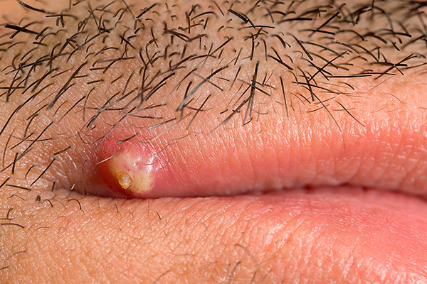 На сегодня не существует ни одного профилактического средства, которое бы гарантировало полное подавление рецидивов лабиального герпеса. На сегодня не существует ни одного профилактического средства, которое бы гарантировало полное подавление рецидивов лабиального герпеса.