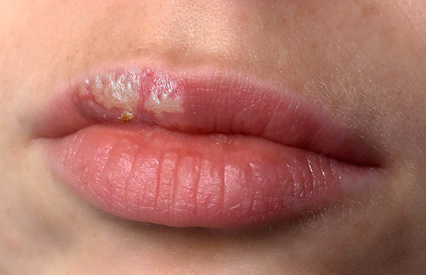 Герпетические папулы на губах Герпетические папулы на губах