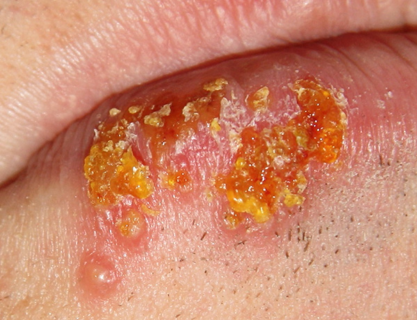 Характерные корки на губах при герпесе. Характерные корки на губах при герпесе.