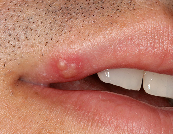 Рассмотрим особенности домашнего лечения герпеса на губах с акцентом на использование современных медицинских препаратов... Рассмотрим особенности домашнего лечения герпеса на губах с акцентом на использование современных медицинских препаратов...