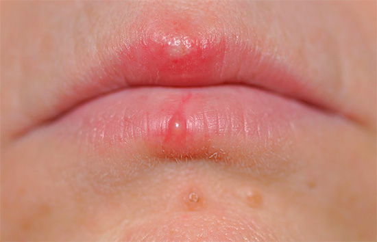 Существует также немало народных средств, позволяющих в той или иной степени облегчить тяжесть симптомов заболевания. Существует также немало народных средств, позволяющих в той или иной степени облегчить тяжесть симптомов заболевания.