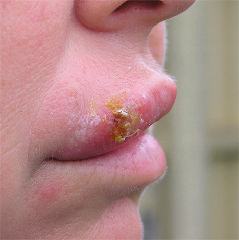 В большинстве случаев герпетические высыпания пытаются лечить, не рассматривая болезнь как серьезную проблему. В большинстве случаев герпетические высыпания пытаются лечить, не рассматривая болезнь как серьезную проблему.