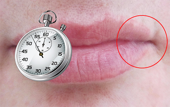 Своевременно начатое лечения нередко позволяет полностью предотвратить появление пузырьков на губах. Своевременно начатое лечения нередко позволяет полностью предотвратить появление пузырьков на губах.