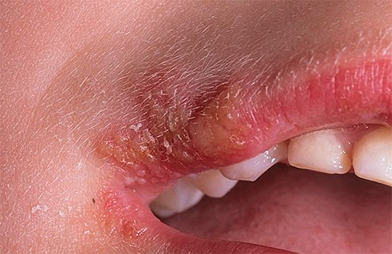 Многие испытывают психологический дискомфорт при наличии герпеса и стараются в это время реже появляться на людях. Многие испытывают психологический дискомфорт при наличии герпеса и стараются в это время реже появляться на людях.