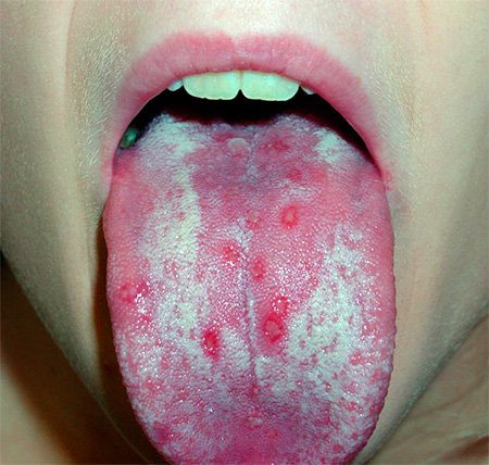 Герпетические язвочки на языке Герпетические язвочки на языке