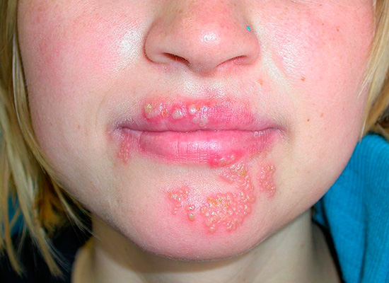 Попробуем выяснить, помогают ли народные средства быстро вылечить простуду на губах... Попробуем выяснить, помогают ли народные средства быстро вылечить простуду на губах...