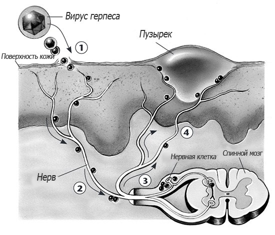 На картинке схематично показано заражение клеток спинного мозга вирусом herpes simplex и последующее проявление болезни на поверхности кожи. На картинке схематично показано заражение клеток спинного мозга вирусом herpes simplex и последующее проявление болезни на поверхности кожи.