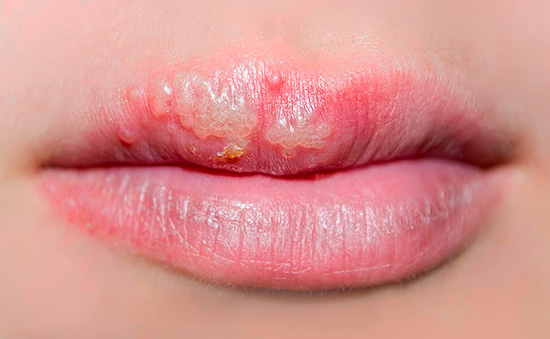 Простуда на губах Простуда на губах