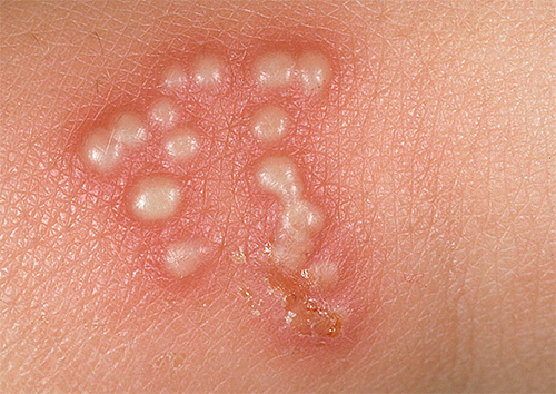 Поговорим о домашних методах лечения проявлений герпеса... Поговорим о домашних методах лечения проявлений герпеса...