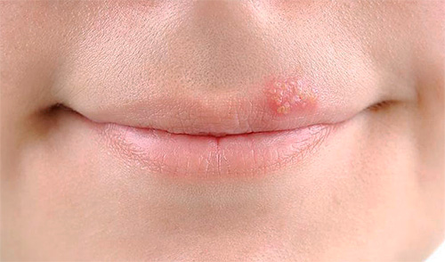 Для лечения простуды на губах в домашних условиях часто используют народные средства, но они в большинстве своем не очень эффективны. Для лечения простуды на губах в домашних условиях часто используют народные средства, но они в большинстве своем не очень эффективны.