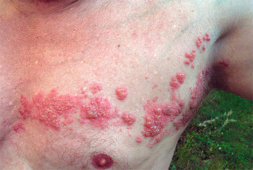 На фотографии показан пример опоясывающего лишая На фотографии показан пример опоясывающего лишая