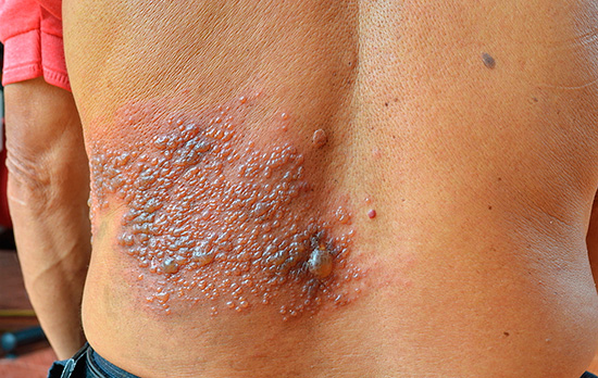 Выясняем, какая медицинская помощь сегодня может быть оказана больному опоясывающим лишаем... Выясняем, какая медицинская помощь сегодня может быть оказана больному опоясывающим лишаем...