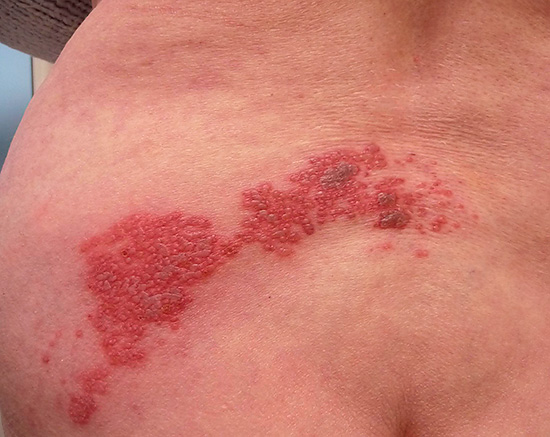 При приеме противогерпетических препаратов сроки излечения обычно заметно сокращаются по сравнению со случаями, когда лечение не производится вовсе. При приеме противогерпетических препаратов сроки излечения обычно заметно сокращаются по сравнению со случаями, когда лечение не производится вовсе.