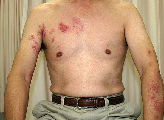 Постгерпетическая невралгия может сопровождаться весьма сильными и длительными болями, которые иногда не проходят в течение многих месяцев. Постгерпетическая невралгия может сопровождаться весьма сильными и длительными болями, которые иногда не проходят в течение многих месяцев.