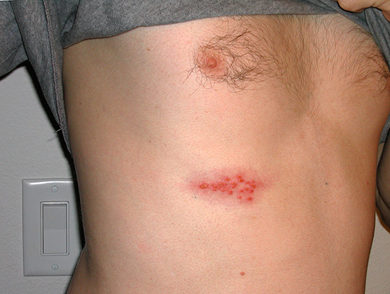 Легкая форма опоясывающего лишая Легкая форма опоясывающего лишая