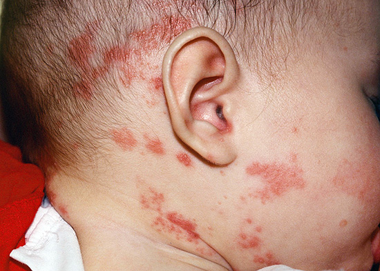 В редких случаях опоясывающий герпес встречается и у детей, причем локализация его может быть самой различной... В редких случаях опоясывающий герпес встречается и у детей, причем локализация его может быть самой различной...