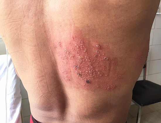 Типичная локализация высыпаний при опоясывающем лишае - на спине, боках, груди и животе. Типичная локализация высыпаний при опоясывающем лишае - на спине, боках, груди и животе.