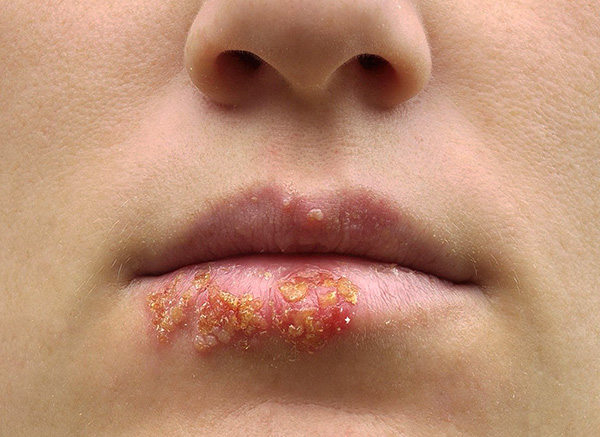 При лечении герпетической инфекции бывает иногда целесообразно применение жаропонижающих, обезболивающих и ранозаживляющих препаратов. При лечении герпетической инфекции бывает иногда целесообразно применение жаропонижающих, обезболивающих и ранозаживляющих препаратов.