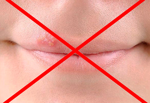 Знакомимся с основами профилактики рецидивов герпетической инфекции... Знакомимся с основами профилактики рецидивов герпетической инфекции...