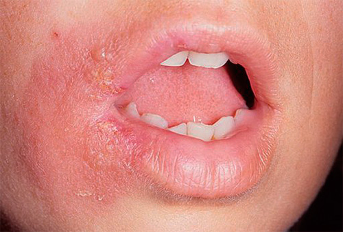 Основной причиной рецидивов простуды на губах является снижение иммунитета организма. Основной причиной рецидивов простуды на губах является снижение иммунитета организма.