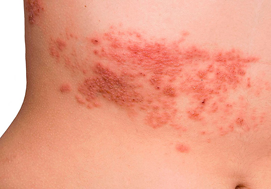 От проявлений опоясывающего лишая не застрахован ни один человек, поэтому полезно иметь хотя бы общее представление об этом заболевании... От проявлений опоясывающего лишая не застрахован ни один человек, поэтому полезно иметь хотя бы общее представление об этом заболевании...