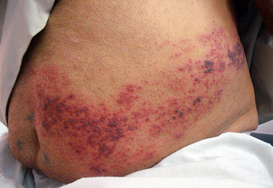 Обычно все симптомы заболевания полностью исчезают менее чем за месяц с момента их появления. Обычно все симптомы заболевания полностью исчезают менее чем за месяц с момента их появления.