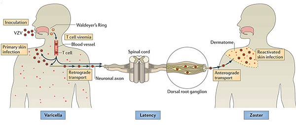 Причиной возникновения опоясывающего лишая является реактивация в организме вируса ветряной оспы (Varicella zoster). Причиной возникновения опоясывающего лишая является реактивация в организме вируса ветряной оспы (Varicella zoster).
