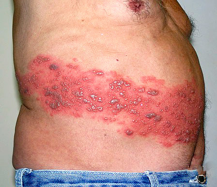 Чем старше человек, тем выше риск появления болезни. Чем старше человек, тем выше риск появления болезни.