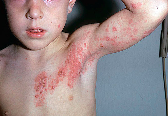 У детей заболевание обычно протекает в легкой форме. У детей заболевание обычно протекает в легкой форме.