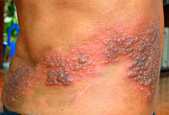 Чаще всего поражается кожа в области поясницы... Чаще всего поражается кожа в области поясницы...