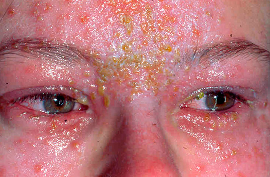 При проявлениях болезни на лице могут серьезно поражаться глаза... При проявлениях болезни на лице могут серьезно поражаться глаза...