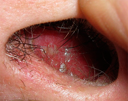 Поражение герпетической инфекцией внутренней поверхности носовых отверстий. Поражение герпетической инфекцией внутренней поверхности носовых отверстий.