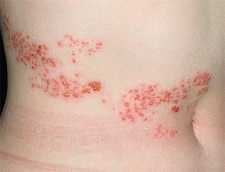 При опоясывающем герпесе повреждаются не только кожные покровы, но и нервные волокна, причем если повреждения нервных клеток значительны, то высок риск развития постгерпетической невралгии. При опоясывающем герпесе повреждаются не только кожные покровы, но и нервные волокна, причем если повреждения нервных клеток значительны, то высок риск развития постгерпетической невралгии.