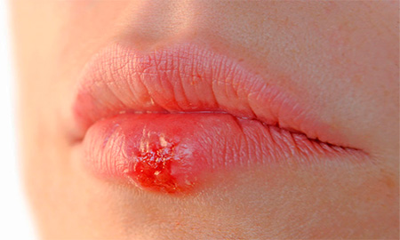 Почему у некоторых людей герпетические высыпания на губах появляются несколько раз в год, а у других - практически никогда?.. Почему у некоторых людей герпетические высыпания на губах появляются несколько раз в год, а у других - практически никогда?..
