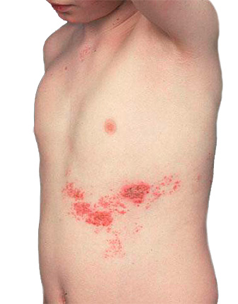 Рецидивы опоясывающего герпеса (опоясывающего лишая) особенно опасны риском возникновения постгерпетической неаралгии, при которой пациент испытывает мучительные боли в течение многих недель, а иногда и месяцев. Рецидив опоясывающего герпеса