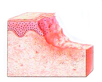 Язвочка, остающаяся после разрыва пузырька. Язвочка, остающаяся после разрыва пузырька.