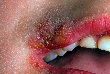 Наиболее характерным признаком заболевания герпетической природы является образование на коже множества язвочек... Наиболее характерным признаком заболевания герпетической природы является образование на коже множества язвочек...