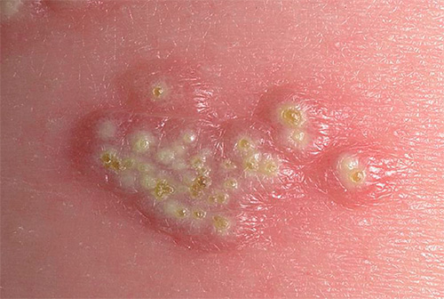 Так выглядят типичные пузырьковые высыпания при герпетической инфекции Так выглядят типичные пузырьковые высыпания при герпетической инфекции