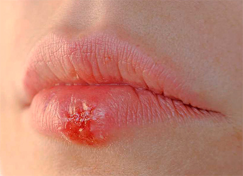 Возможно самостоятельное заражение вагинальным герпесом при переносе вируса с простуды на губах Возможно самостоятельное заражение вагинальным герпесом при переносе вируса с простуды на губах