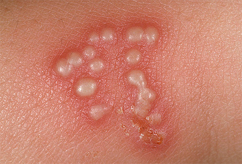 Типичным диагностическим признаком заболевания являются характерные пузырьки на коже Типичным диагностическим признаком заболевания являются характерные пузырьки на коже