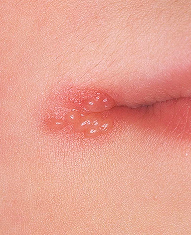 Как правило, простуда на губах проявляется такими вот характерными пузырьками. Как правило, простуда на губах проявляется такими вот характерными пузырьками.