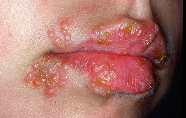 В тяжелых случаях герпетические высыпания охватывают значительную площадь губ и кожи лица... В тяжелых случаях герпетические высыпания охватывают значительную площадь губ и кожи лица...