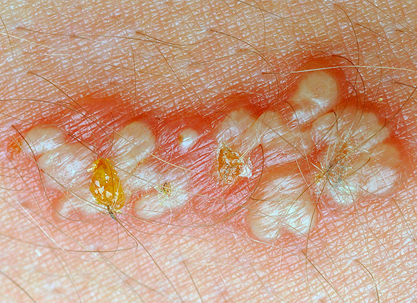 На фотографии показан характерный внешний вид высыпаний при поражении кожи простым герпесом. На фотографии показан характерный внешний вид высыпаний при поражении кожи простым герпесом.