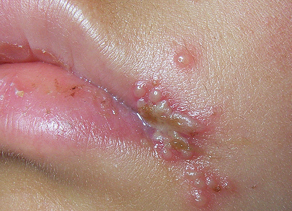 Так выглядит простуда на губах - как правило, она вызывается вирусом ВПГ-1. Так выглядит простуда на губах - как правило, она вызывается вирусом ВПГ-1.