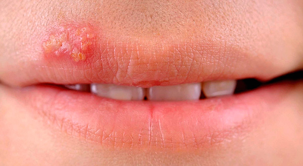 Рецидивы болезни обусловлены неспособностью иммунитета контролировать численность вырабатываемых нервными клетками частиц вируса. Рецидивы болезни обусловлены неспособностью иммунитета контролировать численность вырабатываемых нервными клетками частиц вируса.